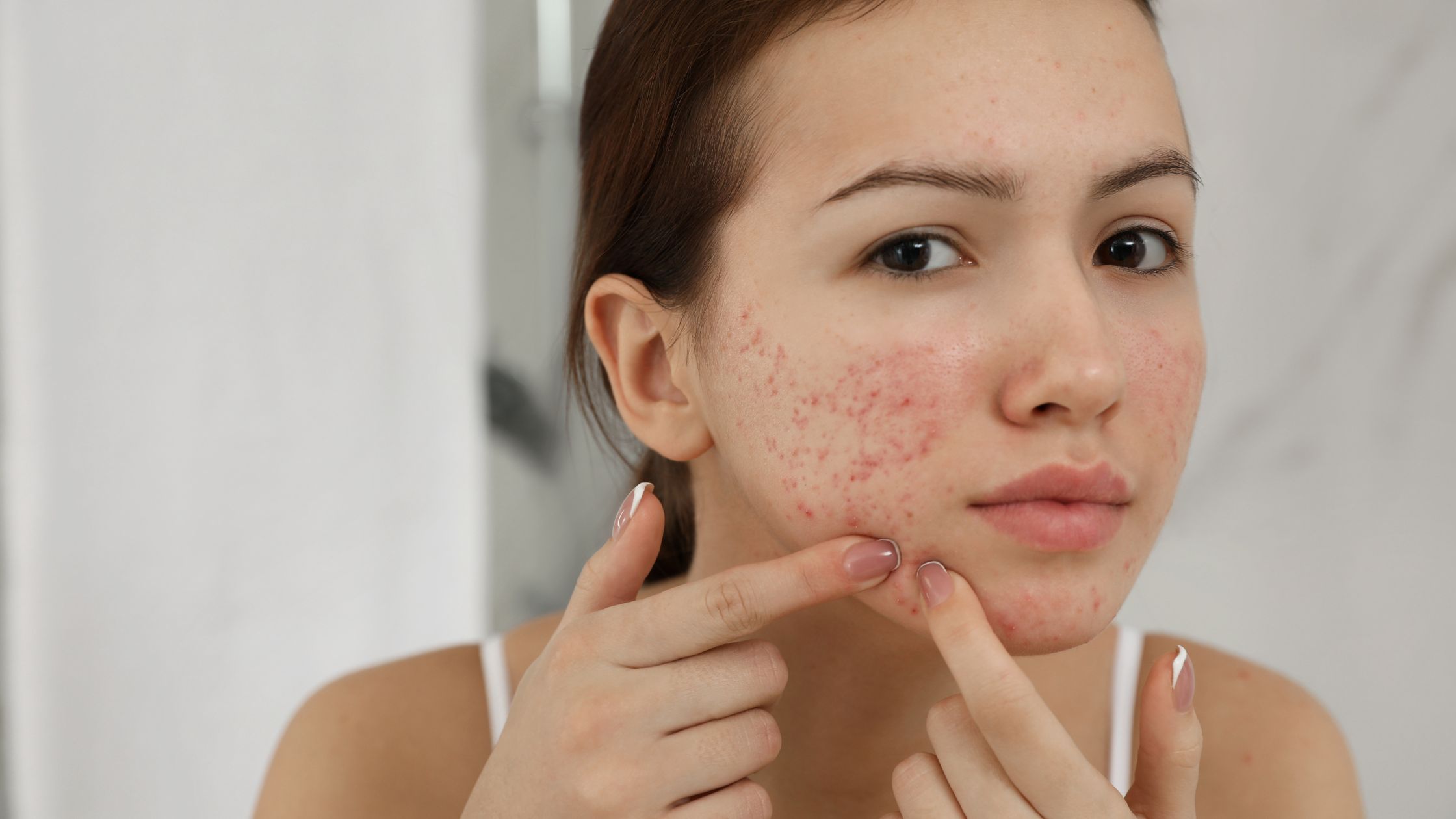 Acne Treatment Package