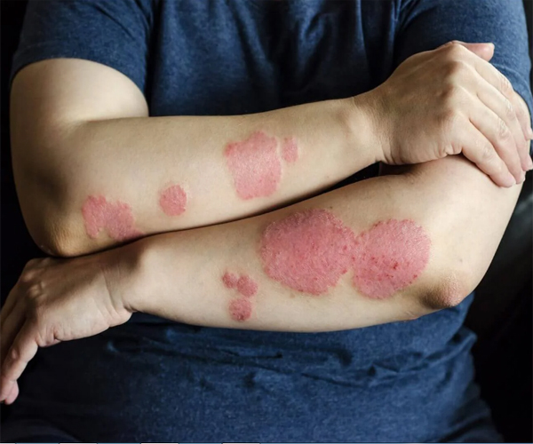 Psoriasis Treatment